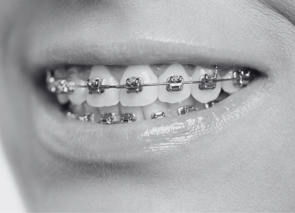 braces 3