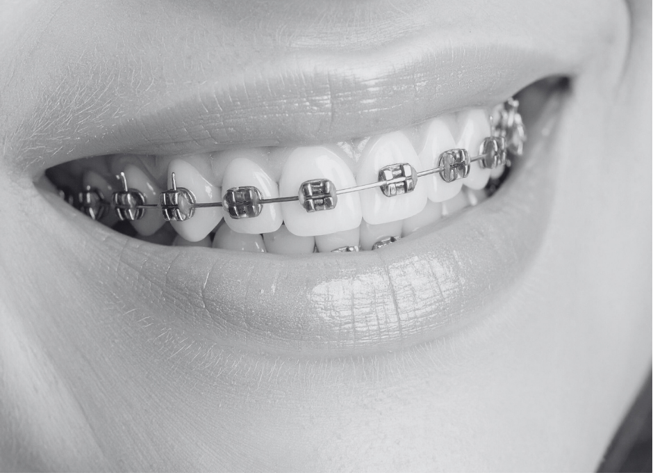 braces 1