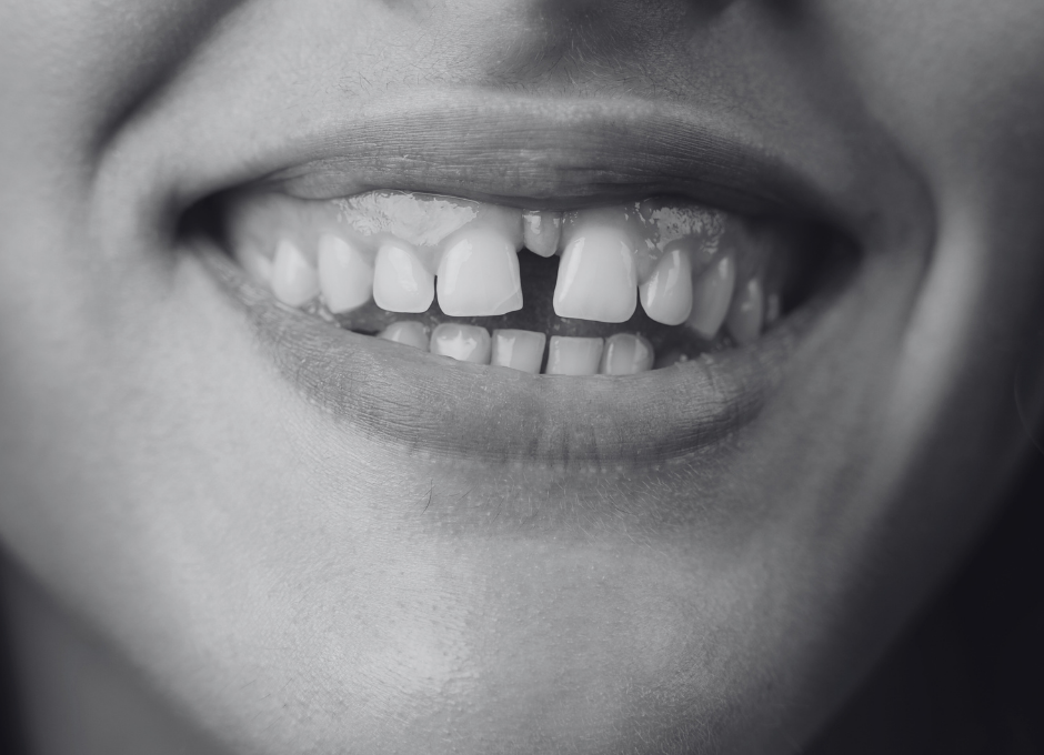 gappy teeth (1)